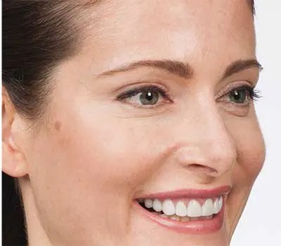 Efter - Botox mod kragetæer