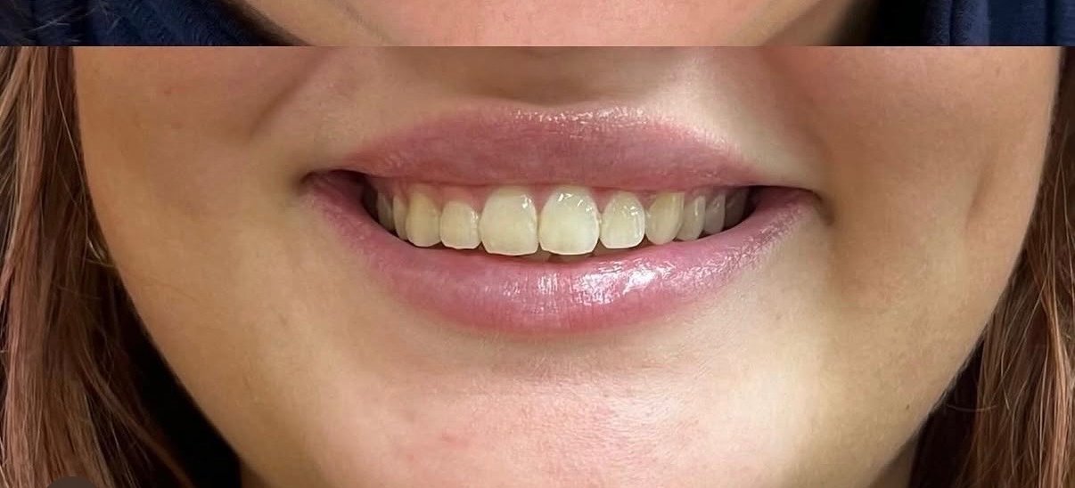 Efter - Botox i læber