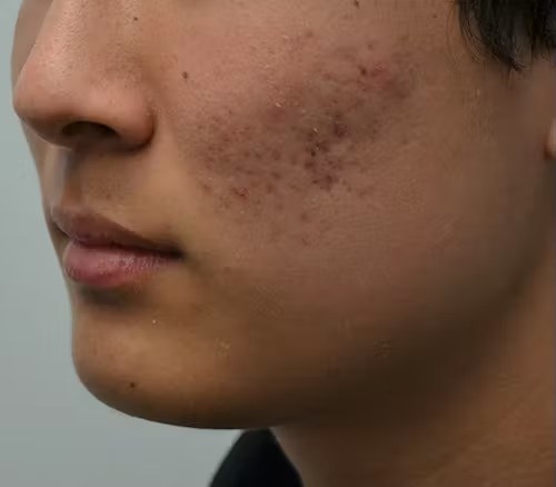Før - Microneedling - porer og ar