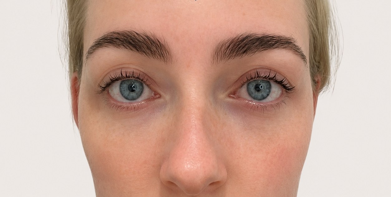 Efter - Polynukleotider under øjnene