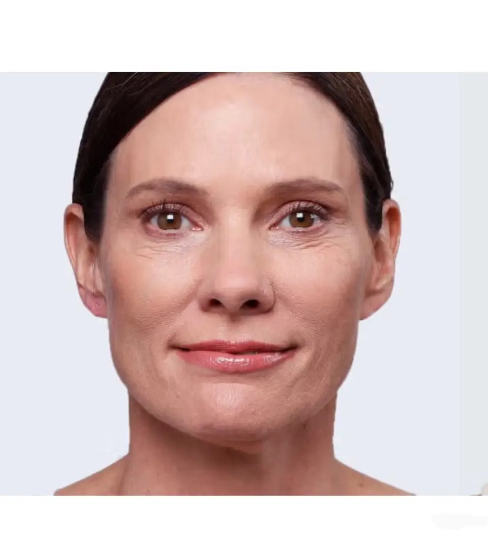 Før - Skinbooster i ansigt